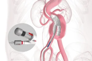 Gore Excluder Conformable AAA Endoprosthesis with ACTIVE Control System