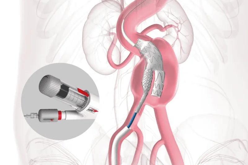 Gore Excluder Conformable AAA Endoprosthesis with ACTIVE Control System